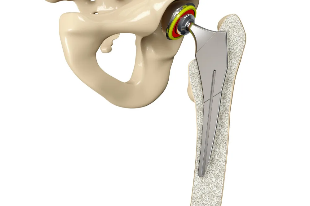 Prótesis de hombro, cadera y rodilla